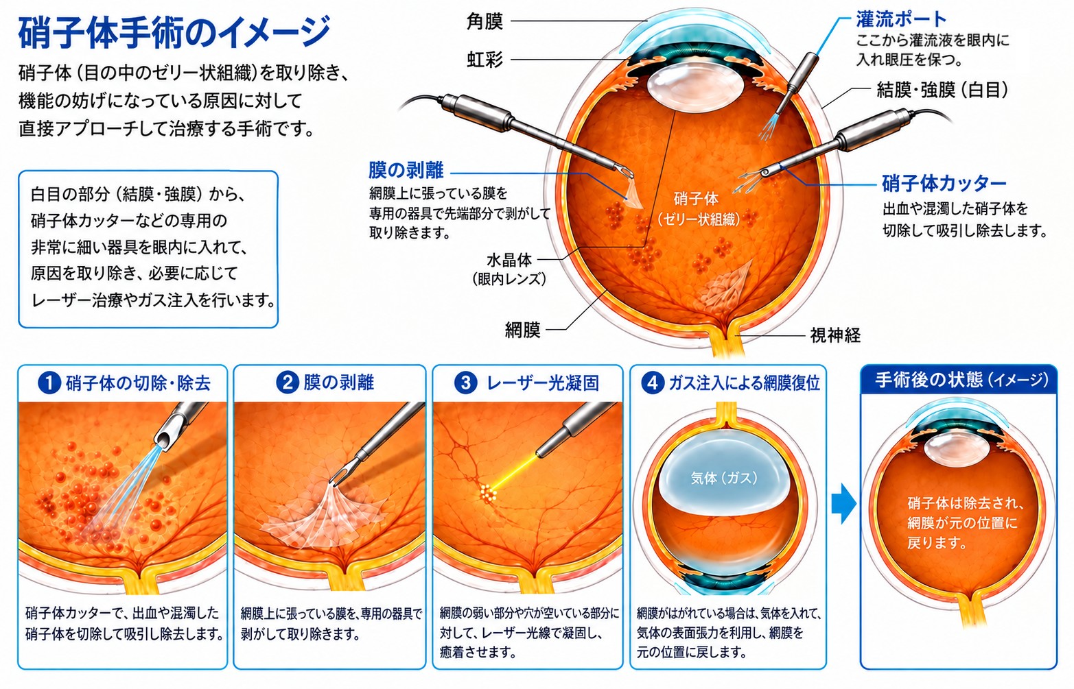 愛知・名古屋エリアで硝子体手術をご検討の方へ｜藤田医科大学病院