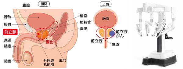 前立腺がんのイメージと手術支援ロボット「ダビンチ」